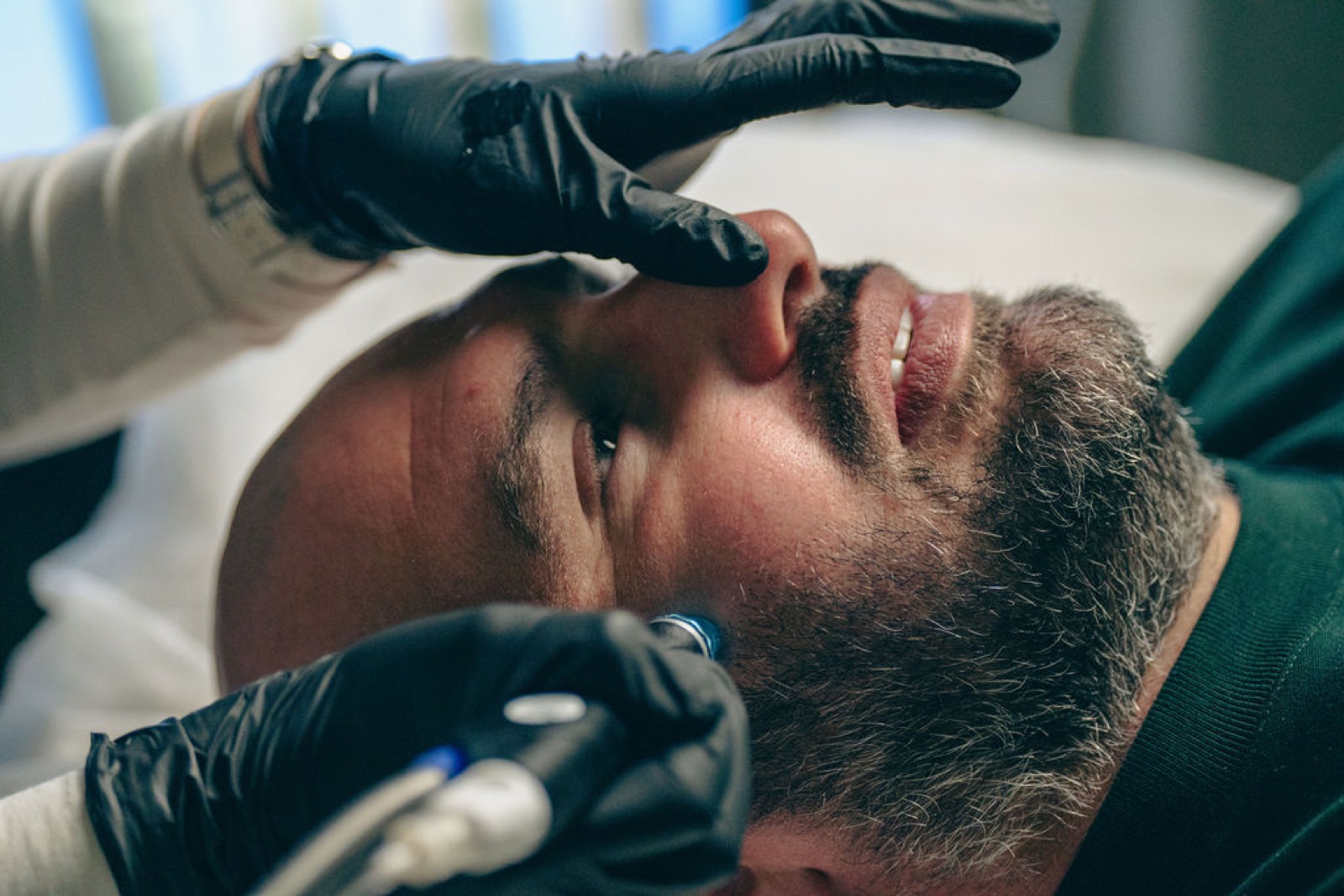 A practitioner performing a microneedling treatment